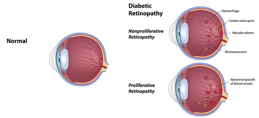 Diabetic Retinopathy