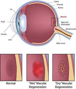 Macular Degeneration